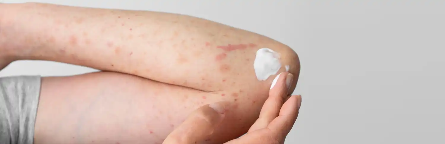 eczema treatment