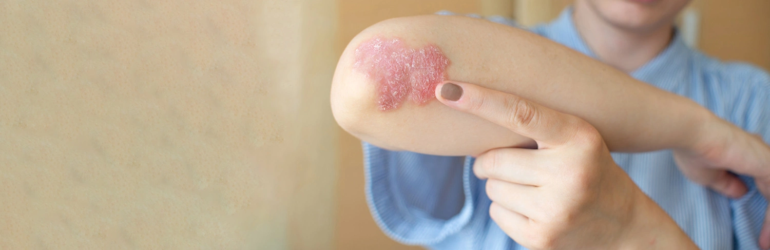 Aluer-Skin clinic in calicut
